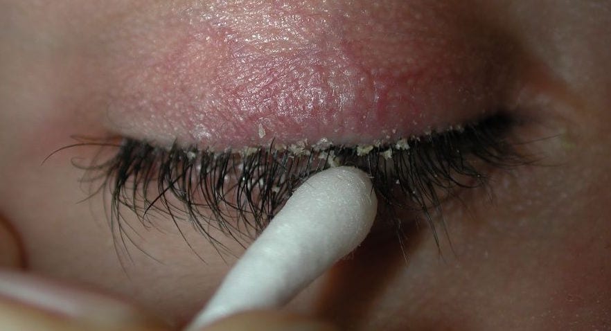 how to get rid of eyelash dandruff