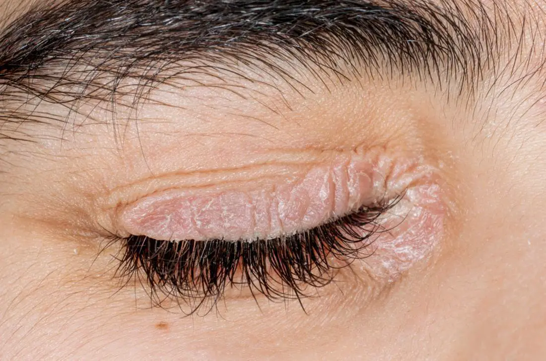 Causes Of Dandruff On Eyelashes And Eyebrows