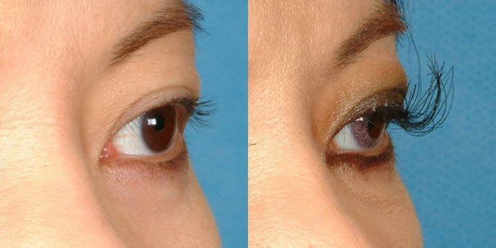 eyelash implants