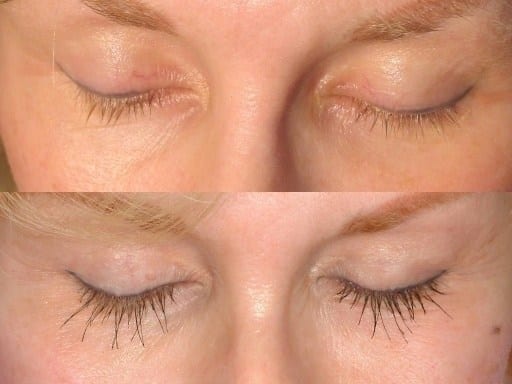 Lash implants deals